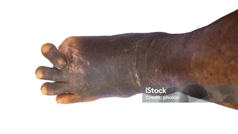 What Are the Symptoms of Leprosy?