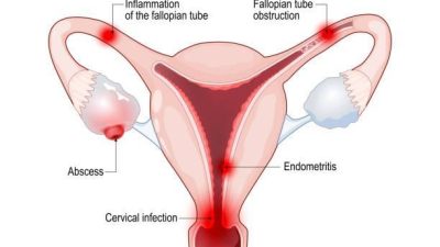 Symptoms and Prevention of Pelvic Inflammatory Disease (PID)