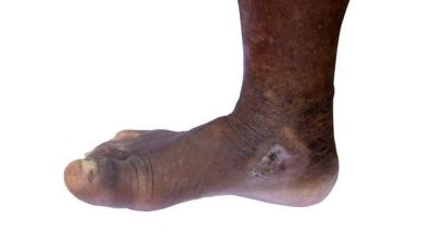 What Are the Symptoms of Ringworm?