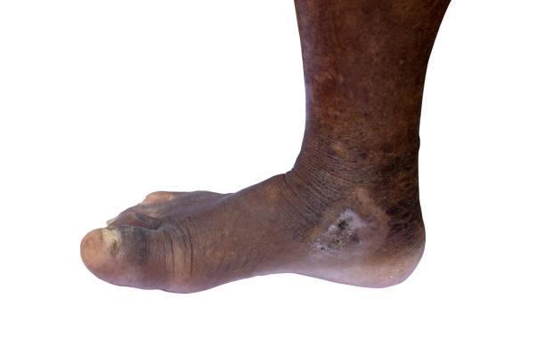 What Are the Symptoms of Ringworm?