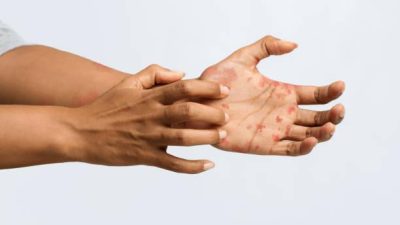 What Are the Symptoms of Skin Psoriasis?