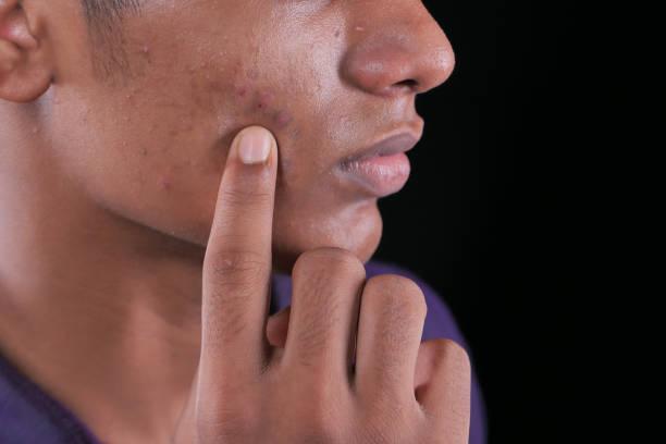 Healthy Tips to Prevent Acne Naturally