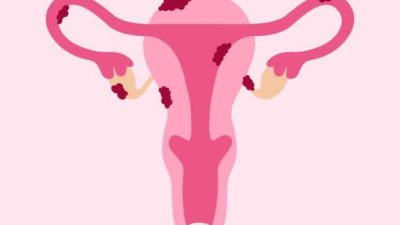How Endometriosis Affects Female Reproductive Health
