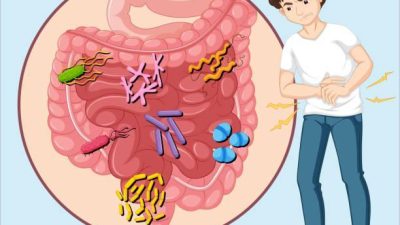 What is Small Intestinal Bacterial Overgrowth (SIBO)