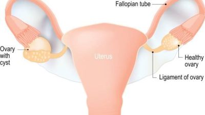 What Causes Ovarian Cysts in Women?