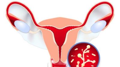 Vaginal Yeast Infection: Causes, Symptoms & Treatment