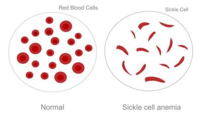 Genotype Compatibility and Sickle Cell Prevention