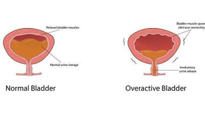 Causes of frequent urination
