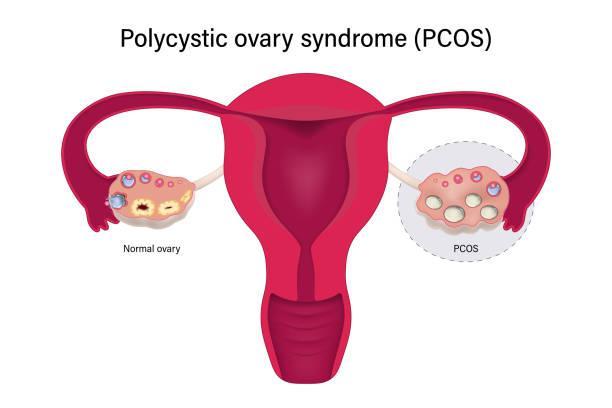 symptoms of PCOS