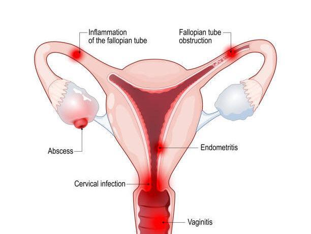 Pelvic Inflammatory Disease