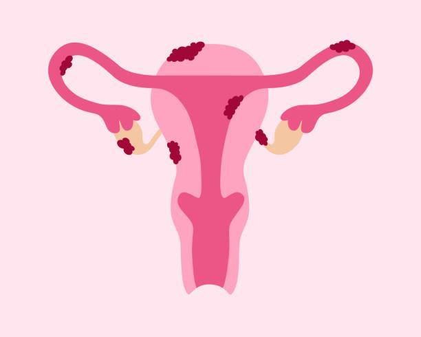Endometriosis Affects Female