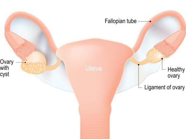 Ovarian Cysts in Women