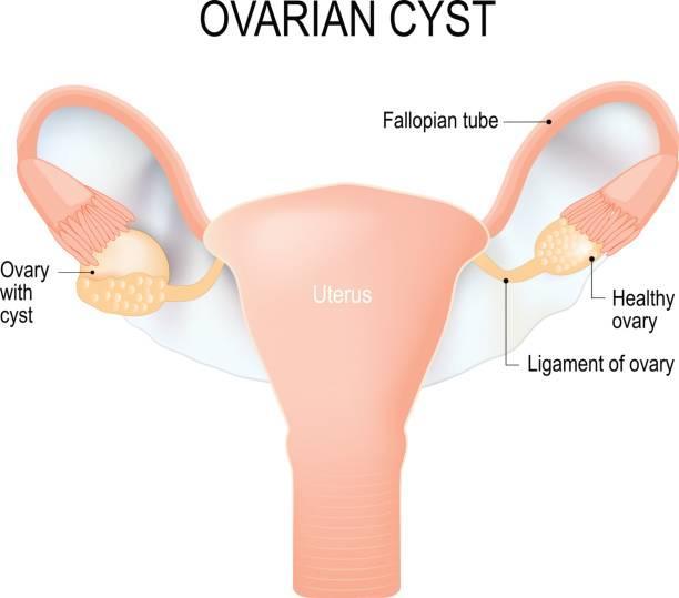 Ovarian Cysts in Women