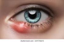 Hordeolum (Swollen Eyelid) Treatment