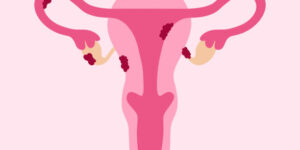 Endometriosis Affects Female