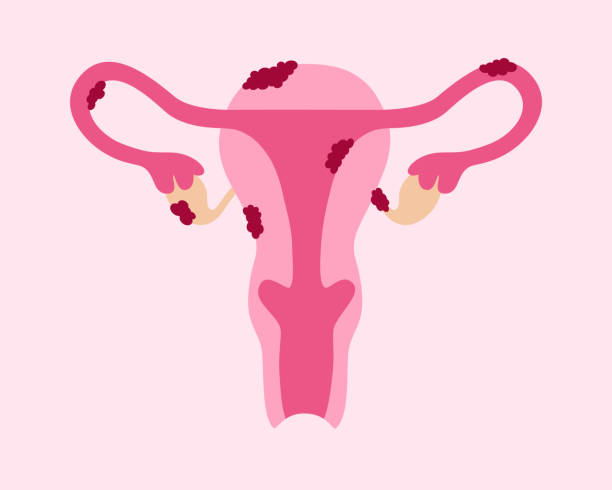 Endometriosis Affects Female