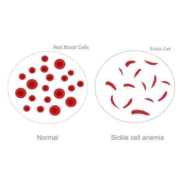Sickle Cell Prevention/ AS genotype in Nigeria